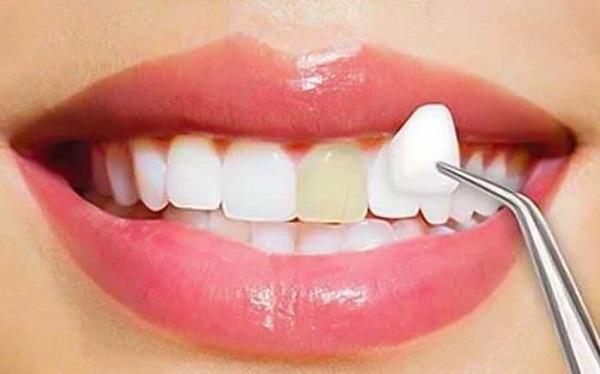 جراحی دندان عقل و لمینت دندان در دندانپزشکی مینوسا